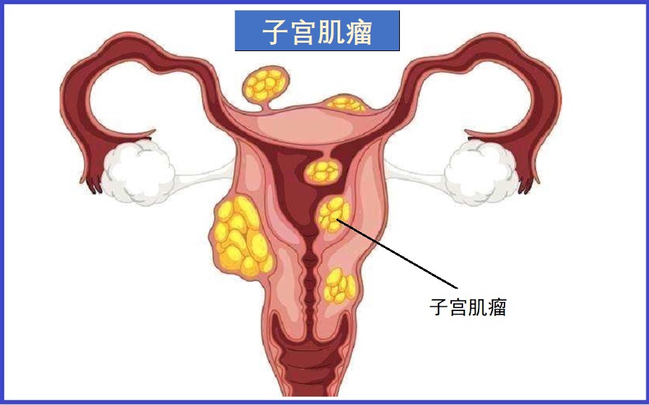  子宫肌瘤