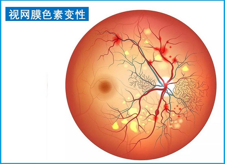  视网膜色素变性