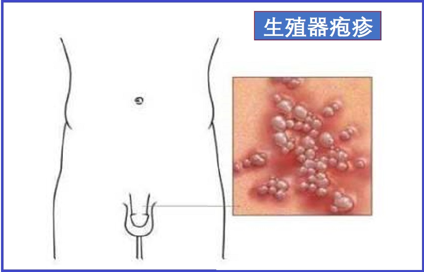  生殖器疱疹