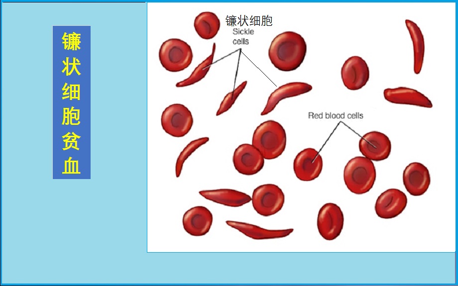  镰状细胞贫血