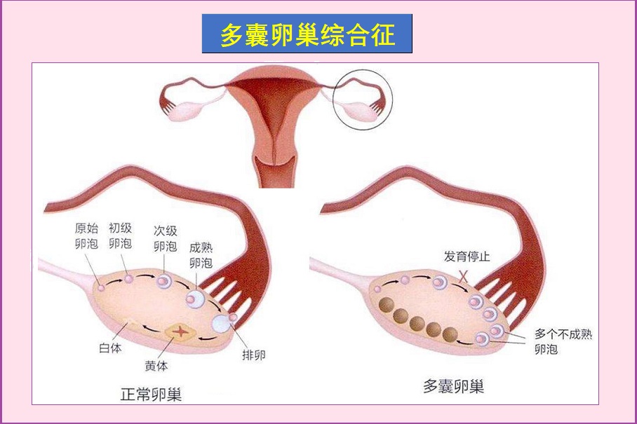  如何调理多囊卵巢引起的月经紊乱？