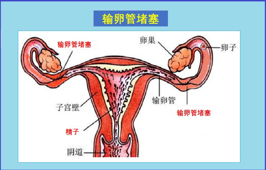  输卵管堵塞与不孕