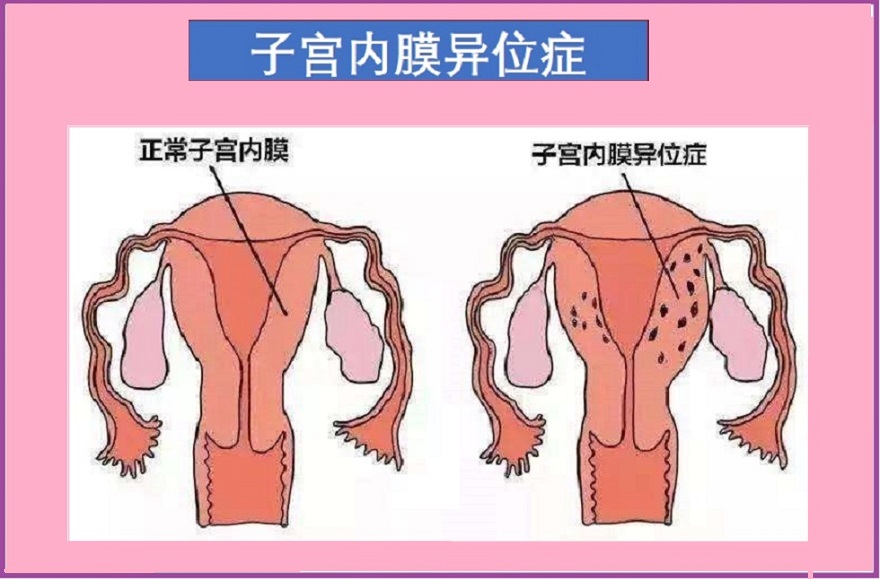  子宫内膜异位症与不孕